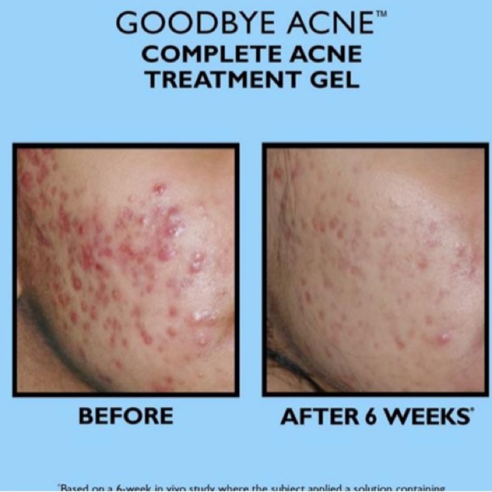 ⚫️ Peter Thomas Roth Goodbye Acne Complete Acne Treatment Gel New 1.7 Full-Size - Picture 4 of 9
